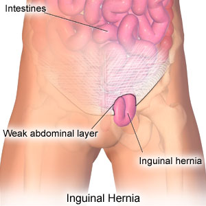 inguinal hernia patch problems