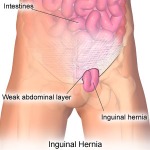 http://piedmont-surgical.com/hernia/inguinal-hernia/*http://www.drugs.com/cg/inguinal-hernia.html